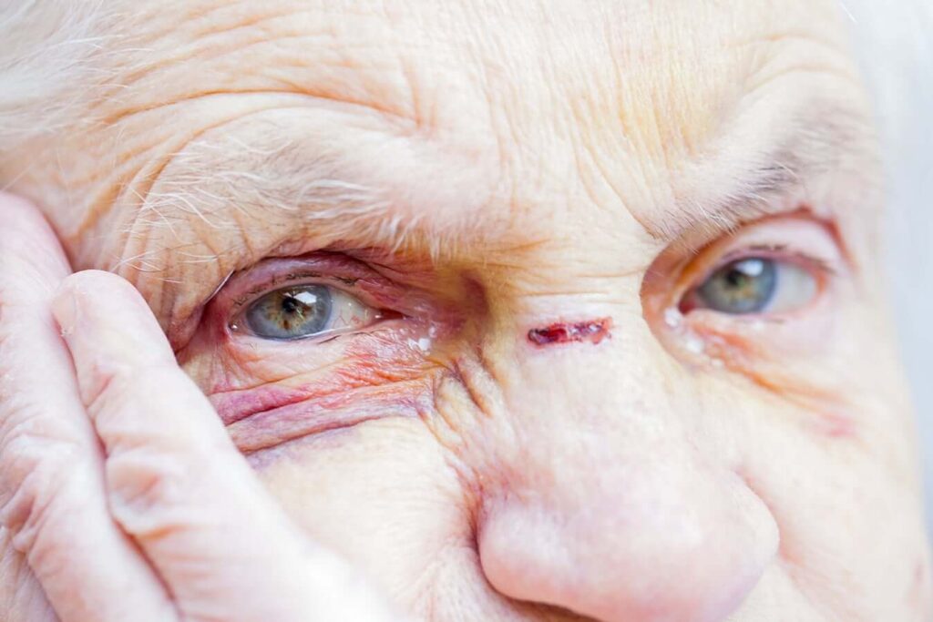 elderly woman with nose injury